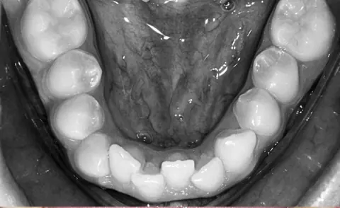 Antes: dentes inferiores apinhados
