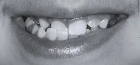 Antes: dentes desalinhados no sorriso