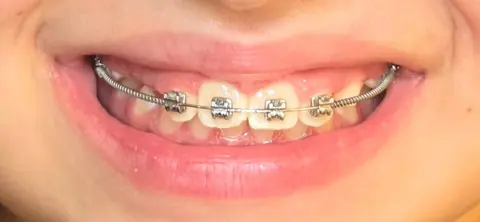 Durante: sorriso com aparelho fixo