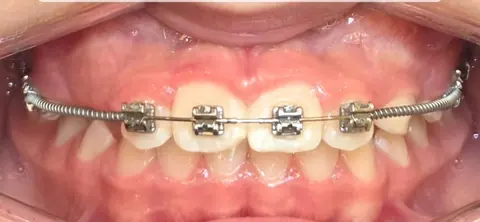 Durante: dentes com aparelho fixo