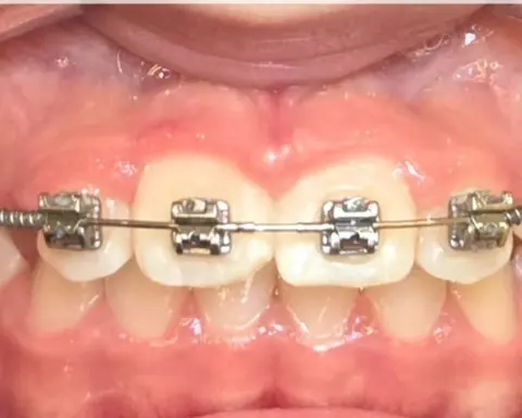Dentes com aparelho ortodôntico fixo