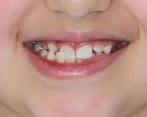 Sorriso de criança com dentes de leite e permanentes