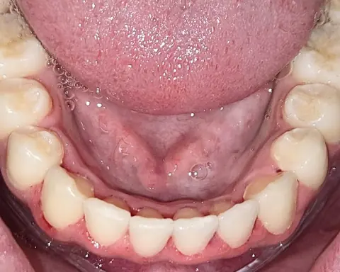 Arcada inferior de adulto com os dentes alinhados